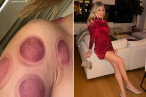 Eugenie Bouchard shares gruesome pictures of cupping treatment days after stunning in leggy red dress for birthday bash